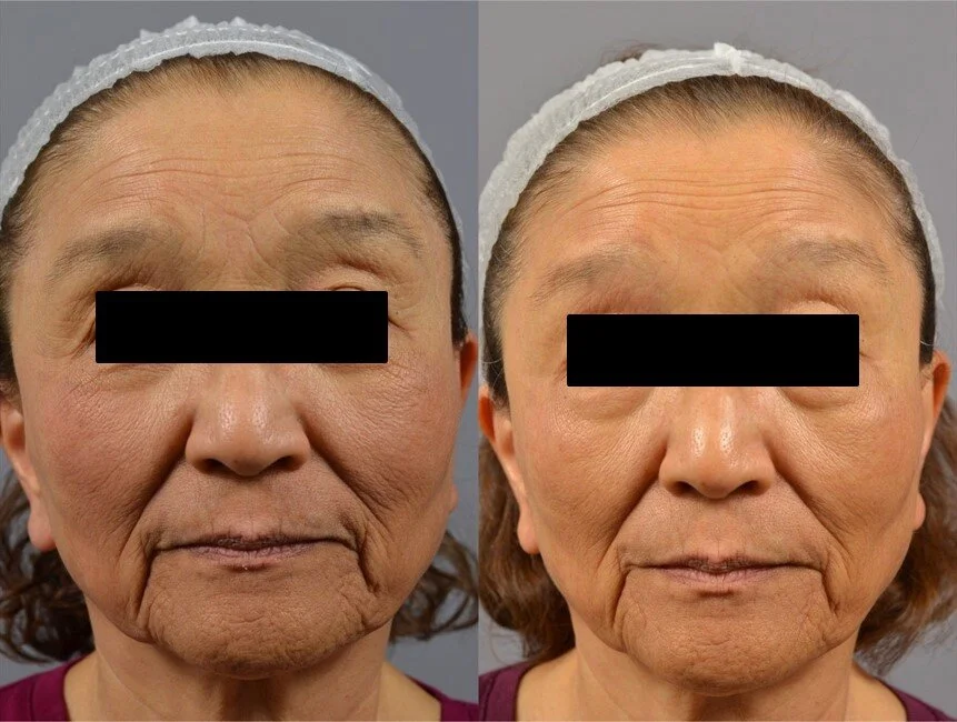 Halo resurfacing for fine lines and pigment.