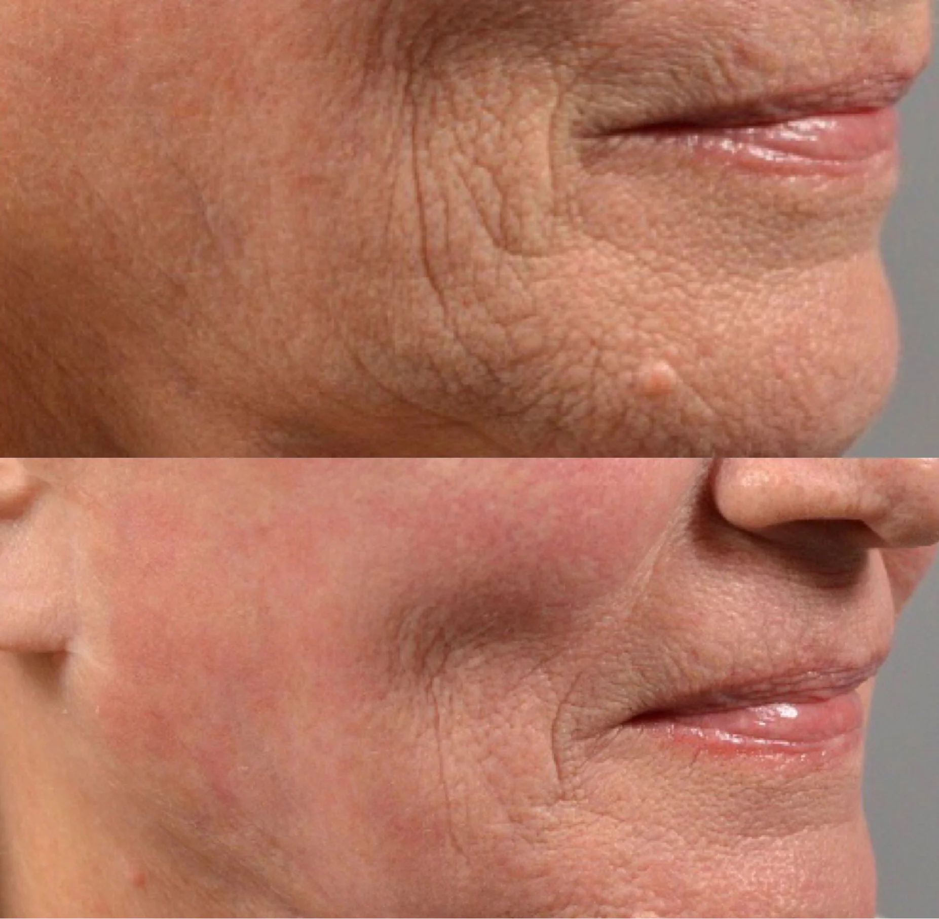 Contour TRL resurfacing for texture and deep wrinkles.