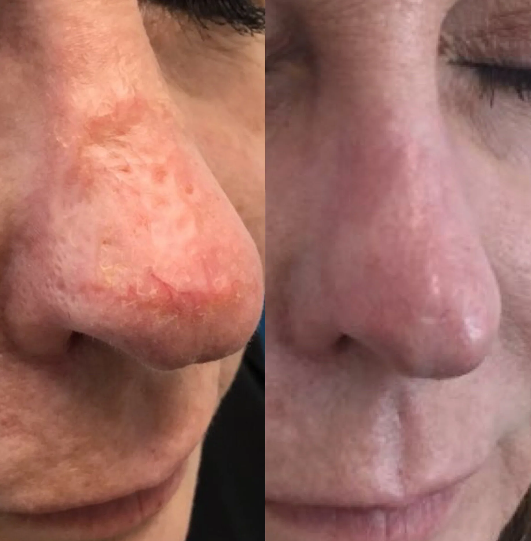 Profractional resurfacing for scars - 3 treatments.
