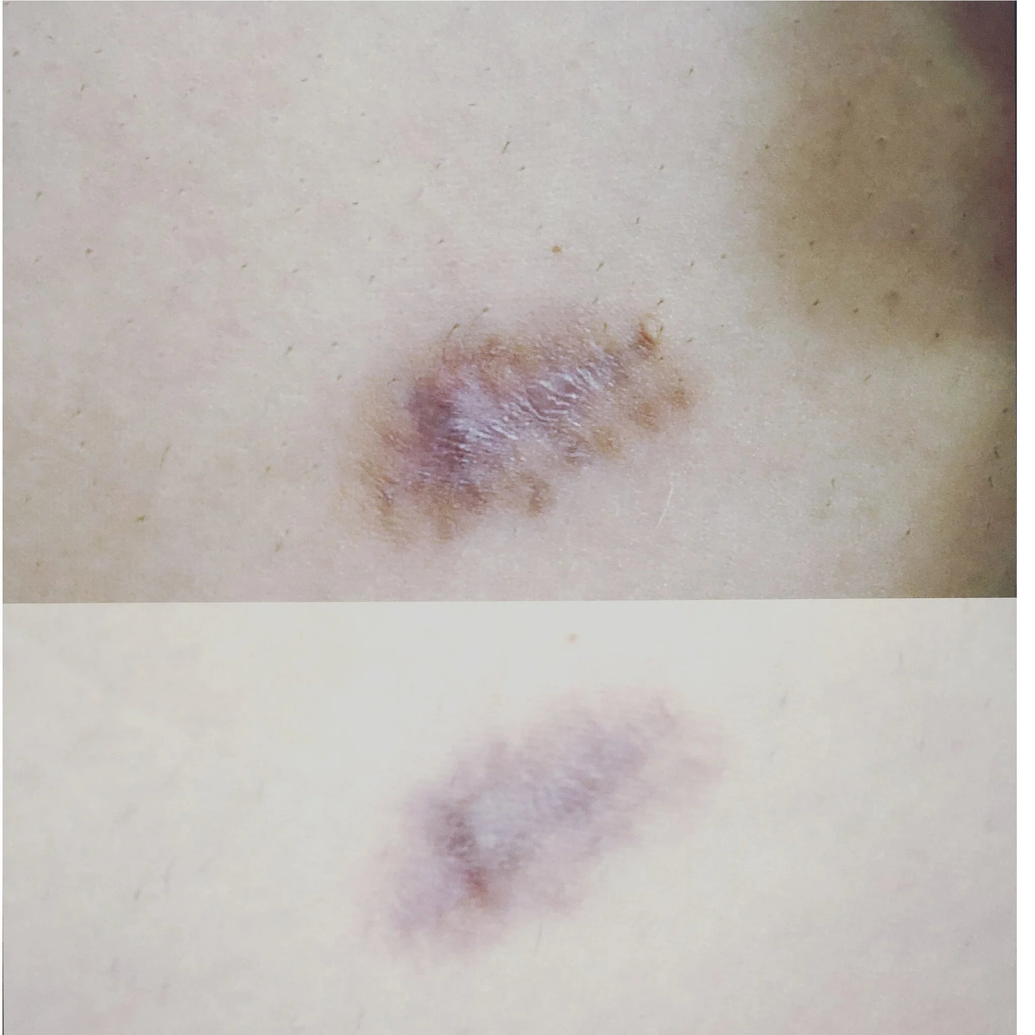 Profractional resurfacing for surgical scar - 2 treatments.