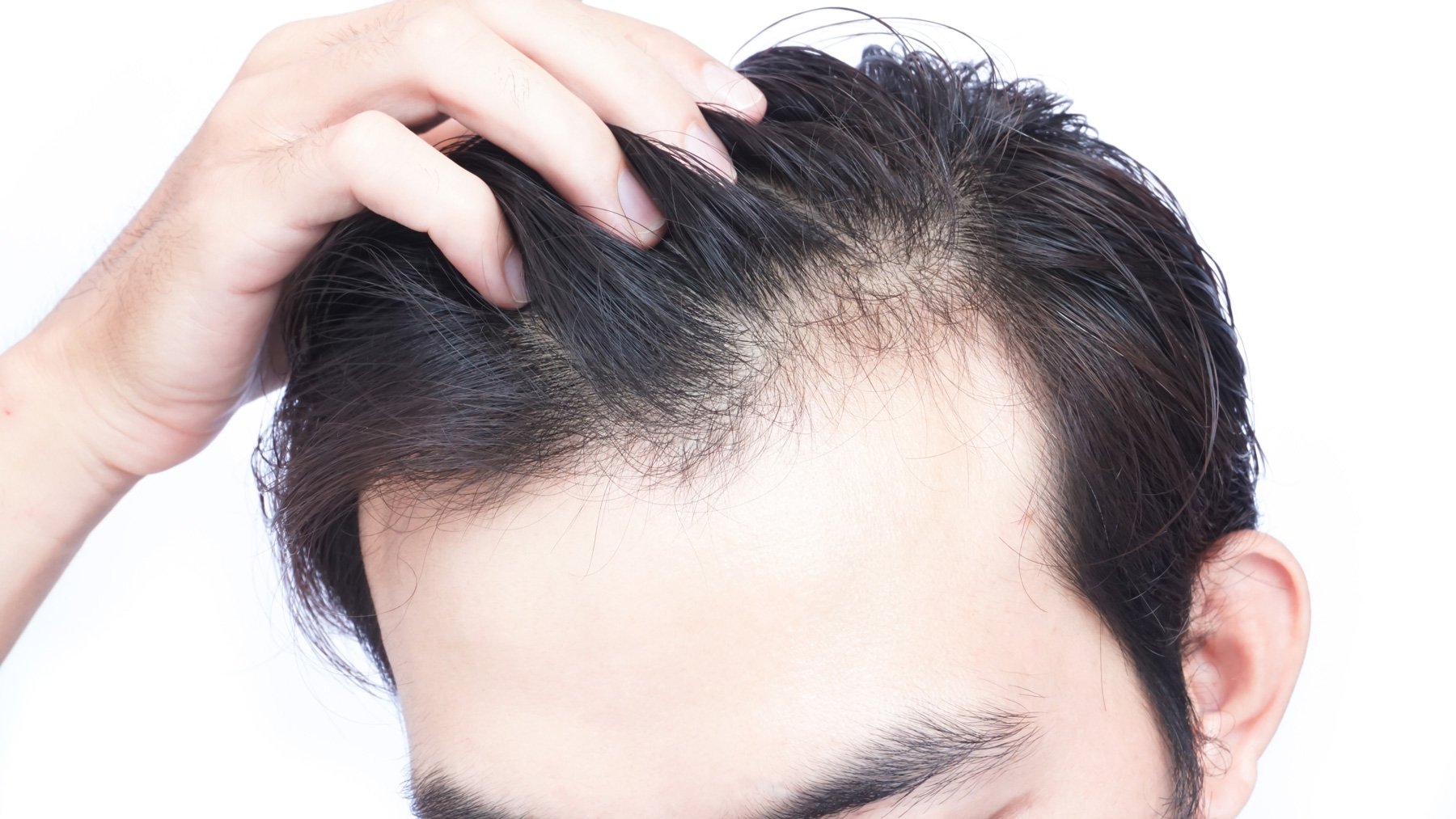 Oral Minoxidil for Hair Loss — Dermatology Arts