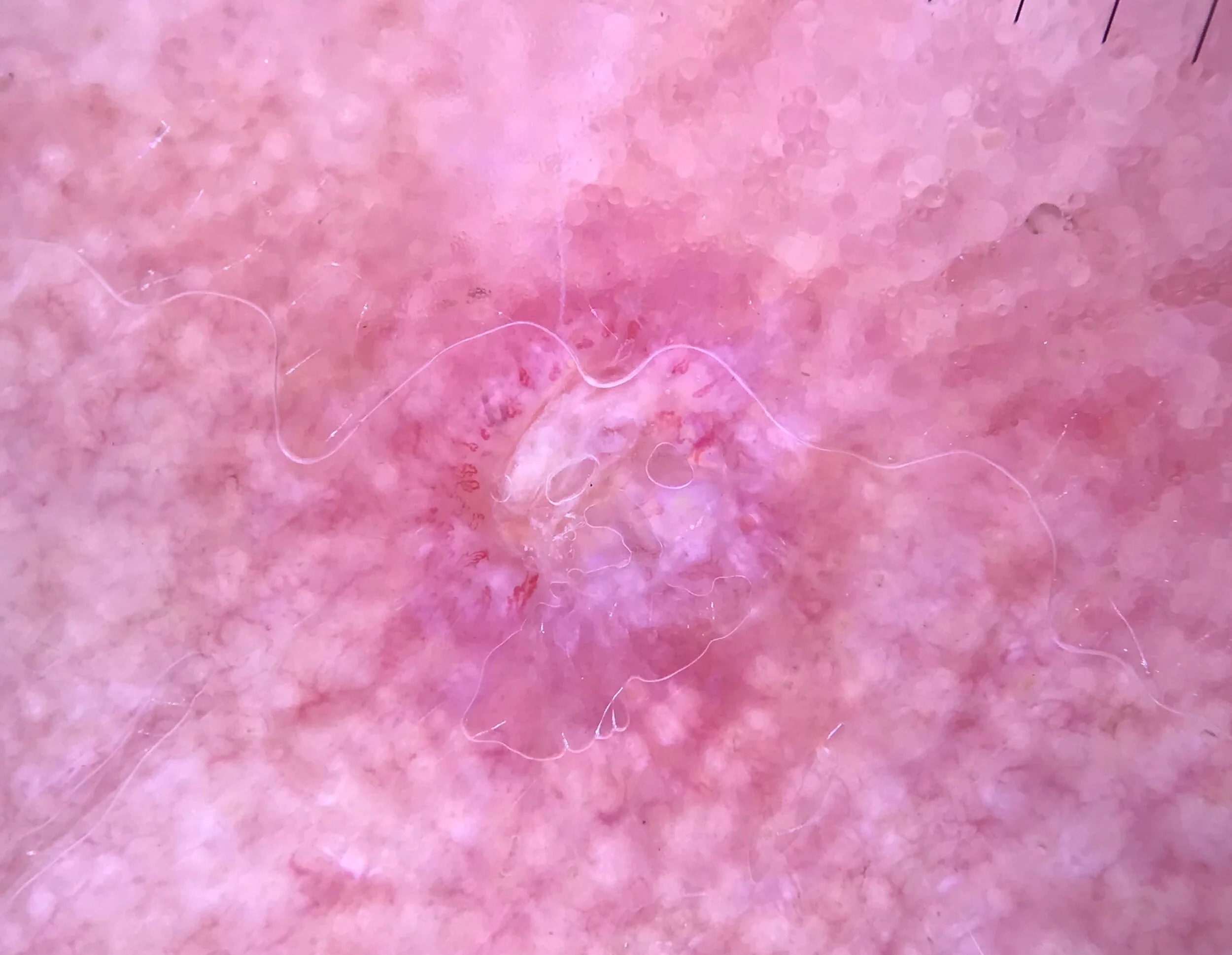 Kontakta Dermatoskopi i primärvård — Dermatoskopi i primärvård Lär dig att diagnostisera hudcancer