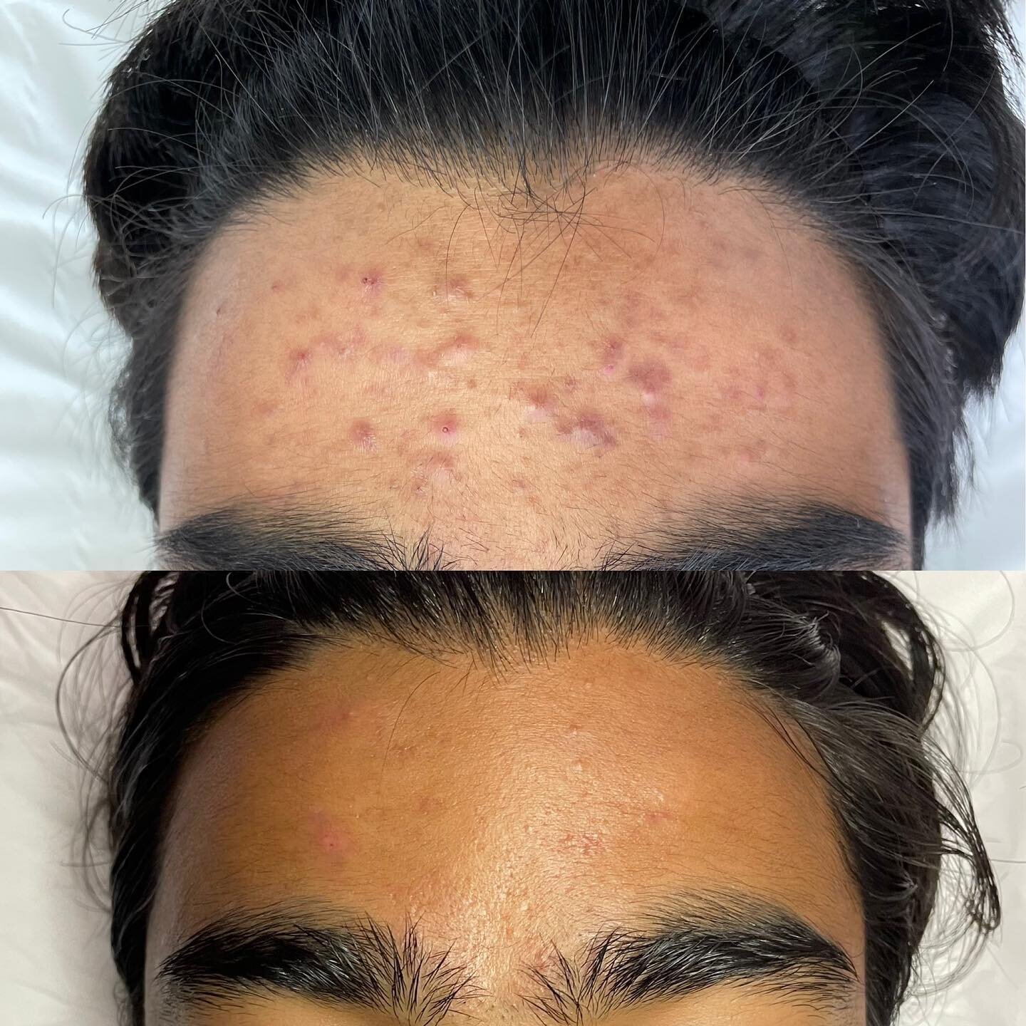 We love giving confidence back to our clients and working with them to achieve long-term skin health.🤍

The most common types of pigment problem with Acne is post-inflammatory hyperpigmentation. This occurs skin injury in the area where pustules, bu