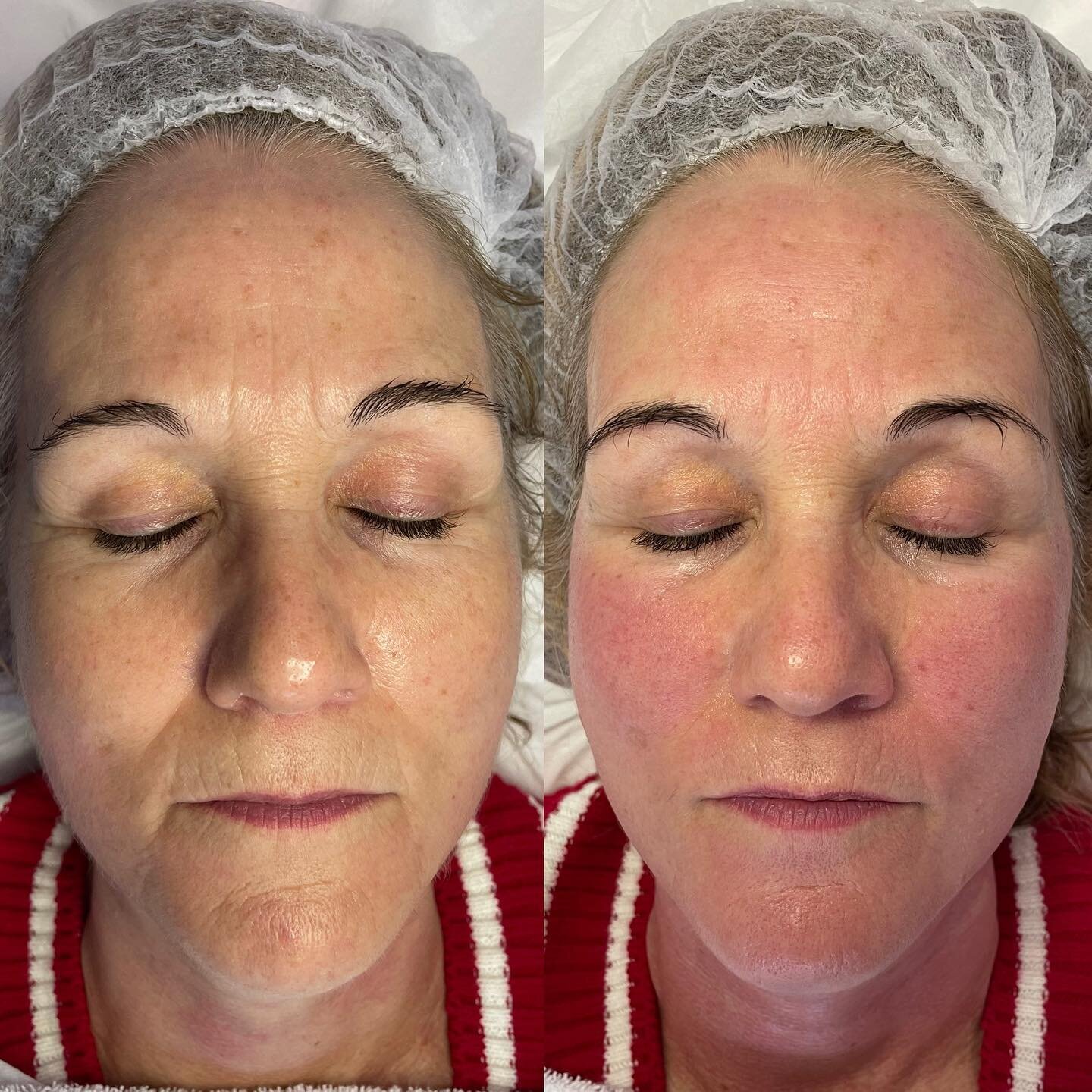 Radio Frequency Micro-needling✔️

Wow theses Results after only one treatment!

Radio Frequency Micro-needling device, which is has been shown to be clinically effective in the treatment of anti-ageing concerns, scar reduction and in the treatment of