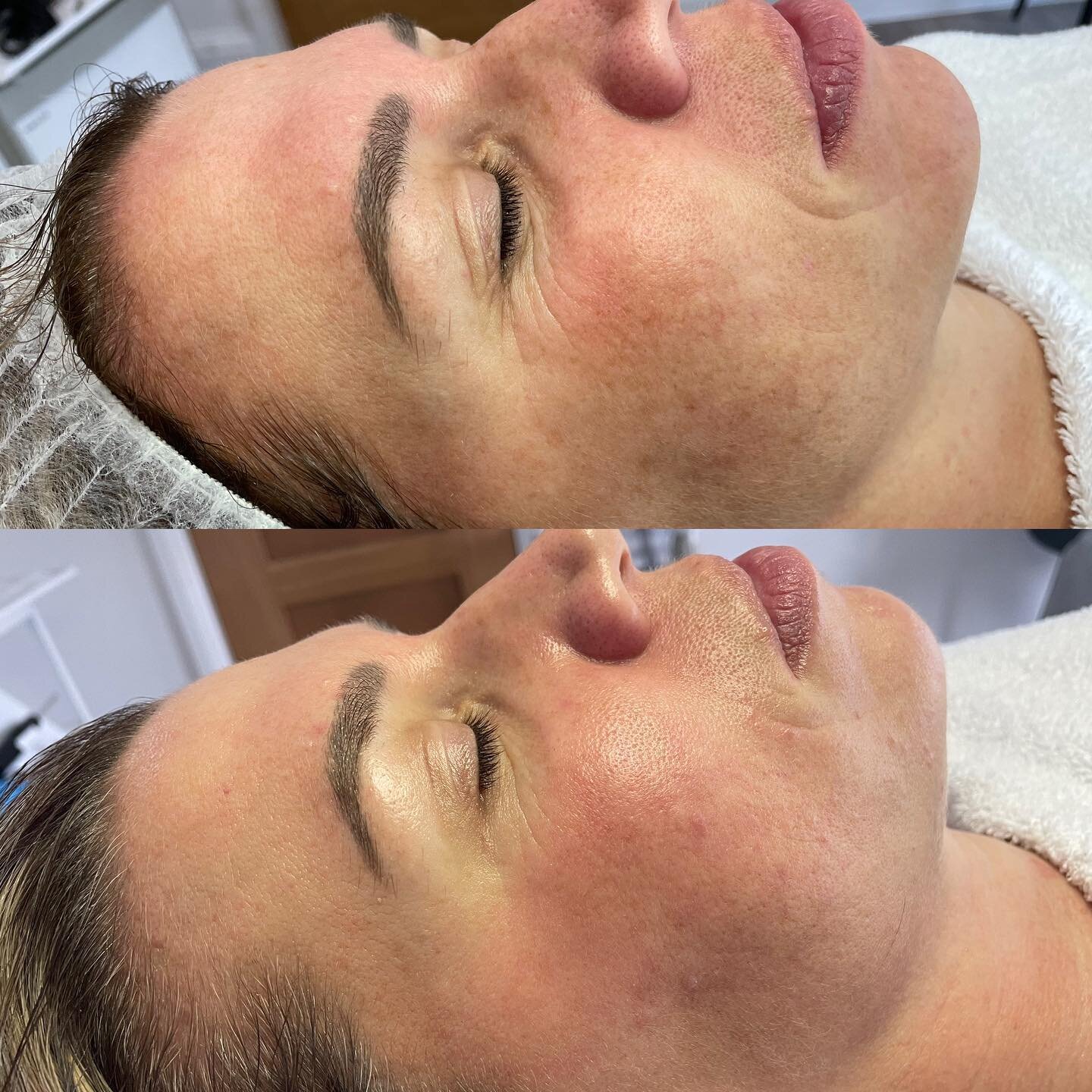 My clients Results after Vitamin C Resurfacer &amp; Nanoneedling treatment ✨

Overall improvement in skin tone, sun-damage and lines around her eyes and nasolabial folds have significantly improved. 

Clients results are only going to improve with re