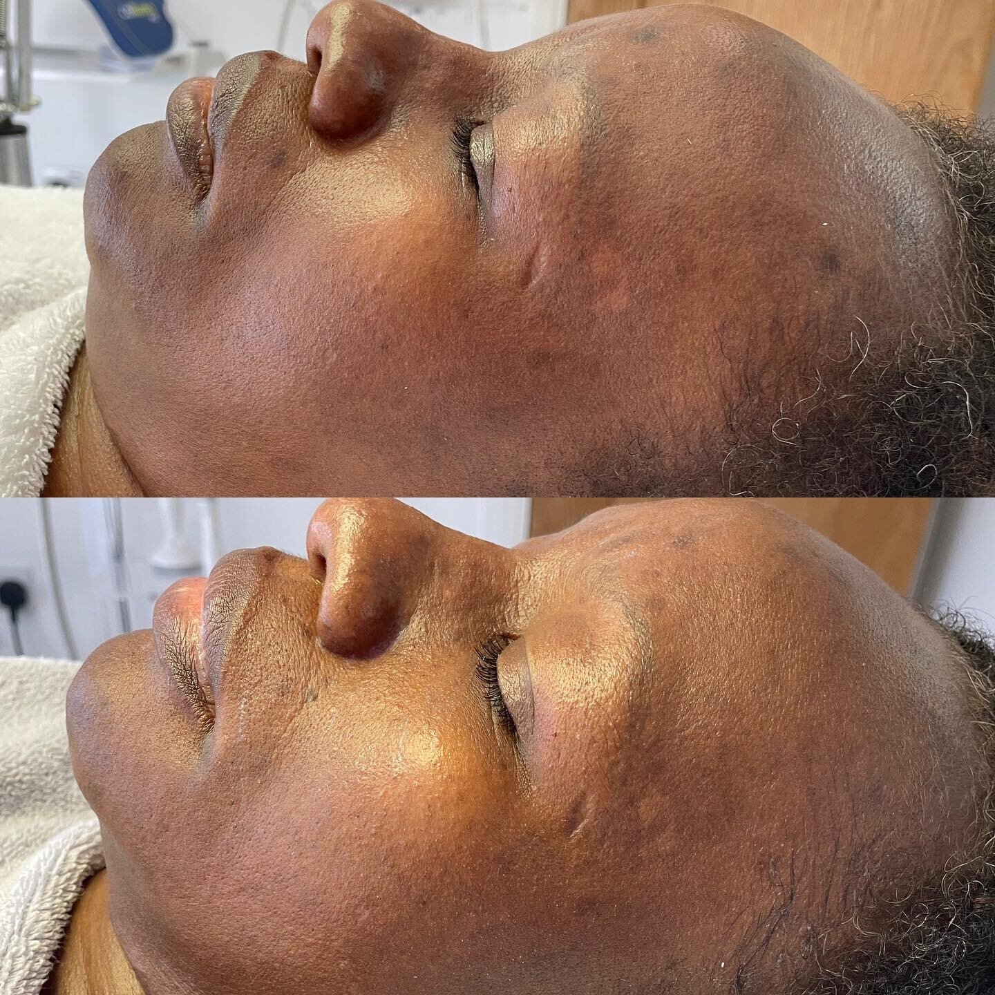 Depigmentation Treatment. Results to be continued for this client, can&rsquo;t wait to see the end result ✨

MELA Resurfacer is one of our most effective skin treatments that treats melasma, reduces skin pigmentation and evens skin tone. 

Book in fo
