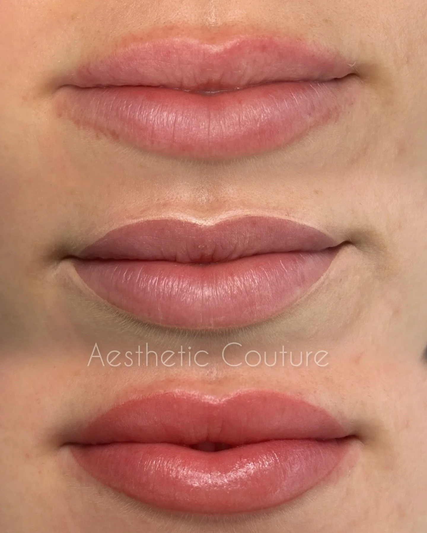 A Different Approach to Lip Enhancement

These lip makeovers are incredibly rewarding! Right from the start of the session, I sensed this client would be tough to impress. She had specific ideas about the shape, but we had a great time fine-tuning ev