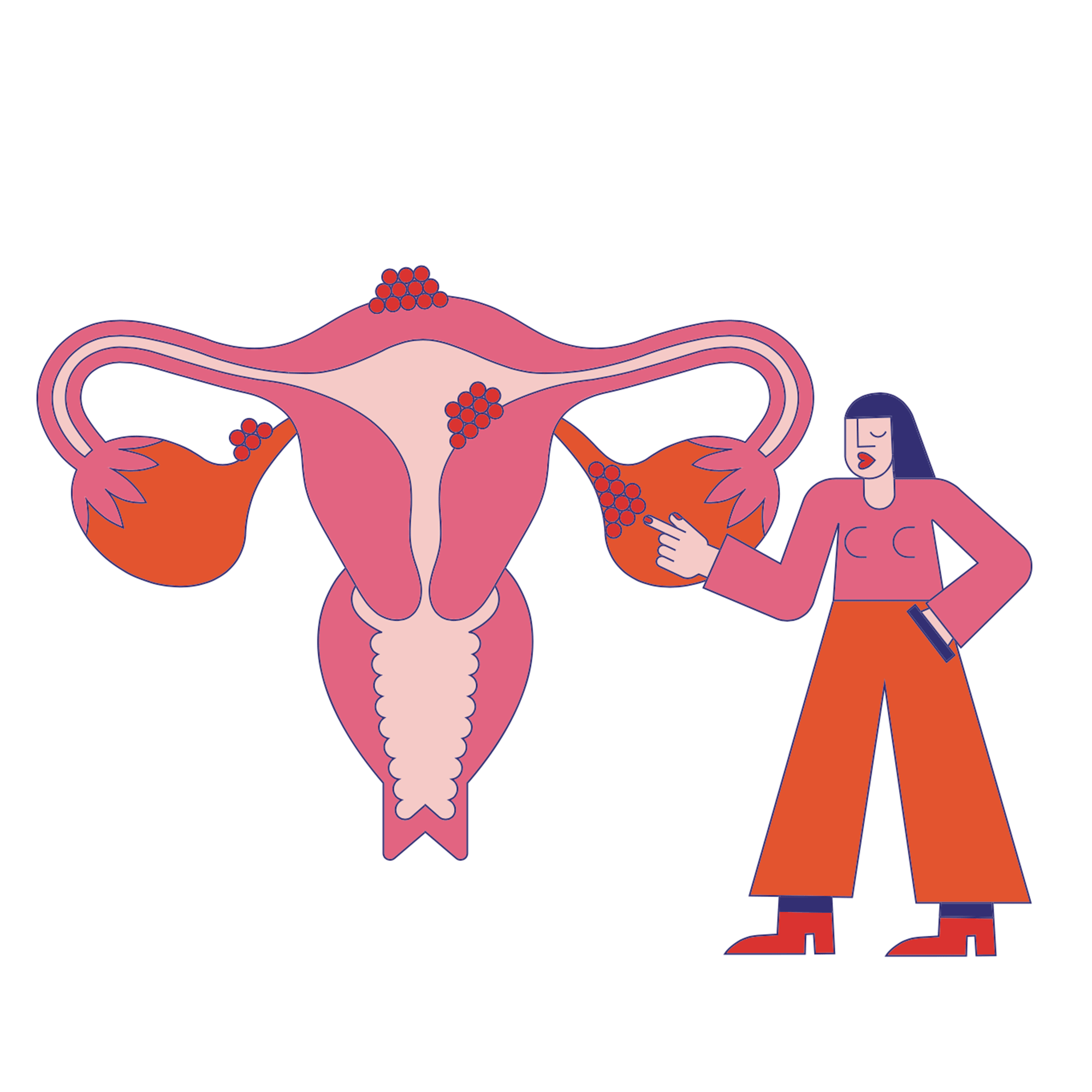 endometriose.gif