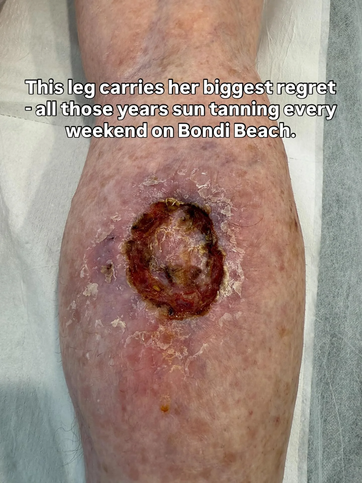 I won&rsquo;t put a &ldquo;⚠️ graphic photo warning&rdquo; on this.

If you&rsquo;re brave enough to keep tanning despite knowing what UV damage can do to your skin, then you should be brave enough to look at what it can cause.

This was my patient&r