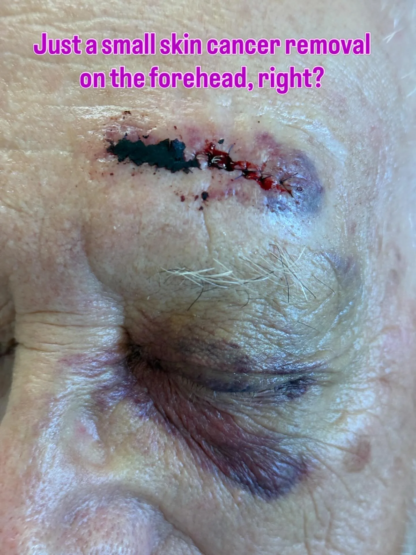 A tiny skin cancer removal on the forehead&hellip; but the bruising ends up here. Then you have to joke about &ldquo;you should see the other guy&rdquo;. 

This is why I always tell my patients - timing matters.

The skin around the eyes and forehead