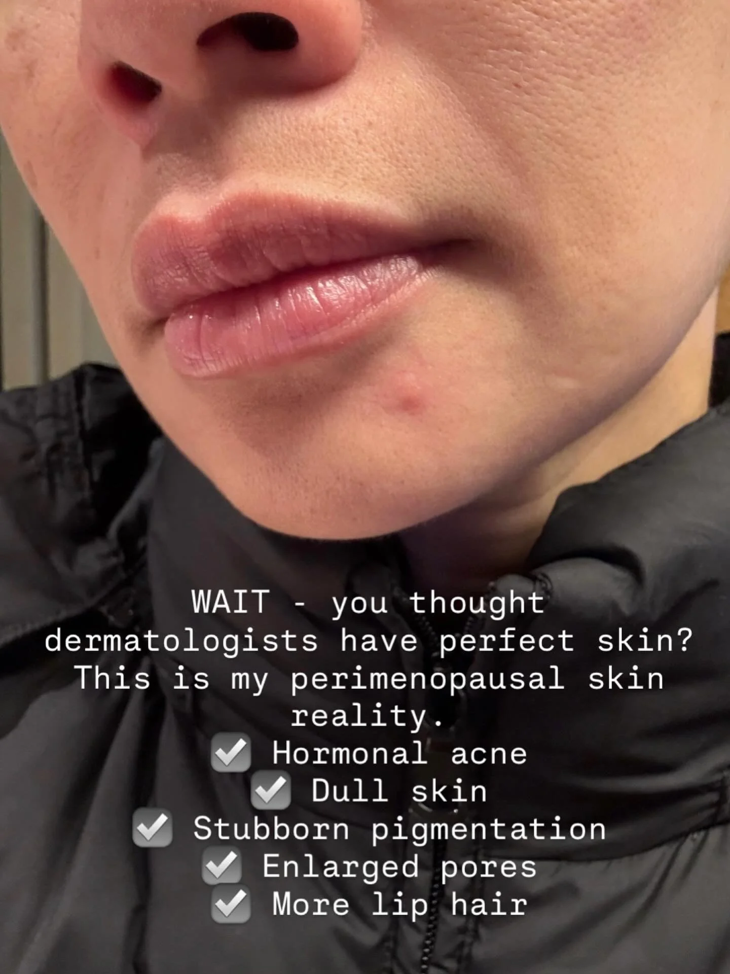 Can we normalise this for a second? 

I&rsquo;m a dermatologist&hellip; and this is my skin right now.

Every day, I&rsquo;m asked what to do about skin changes in perimenopause - but it hits differently when it&rsquo;s my own face in the mirror.

Th