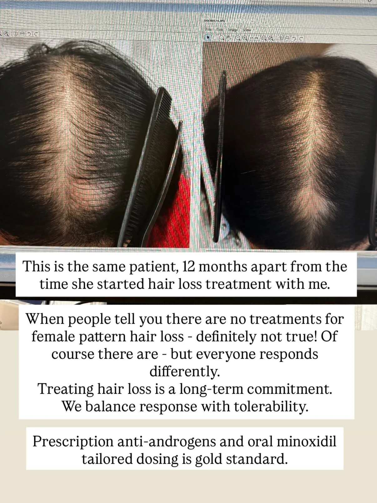 Regrowth is an expectation of treatment for female pattern hair loss these days - but it takes the right strategy AND patience. 

Trust the process - my famous last words. 

This patient&rsquo;s progress here is relatively fast - many women take long