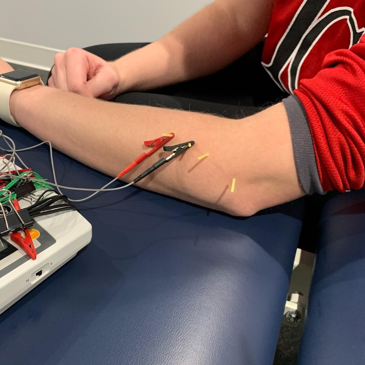 Dry needling is an intervention where thin, monofilament needles are used to stimulate underlying neural, muscular, and/or connective tissues for the management of pain and disability associated with neuromusculoskeletal conditions. Stop by EKYSOPT t