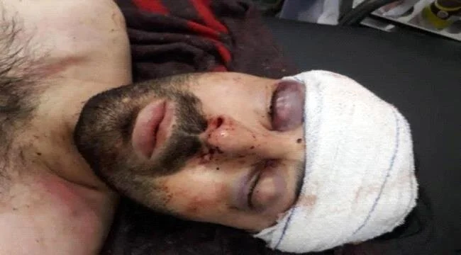 Samafale Turki ah oo lagu dhaawacay magaaladda Cadan ee dalka Yaman.