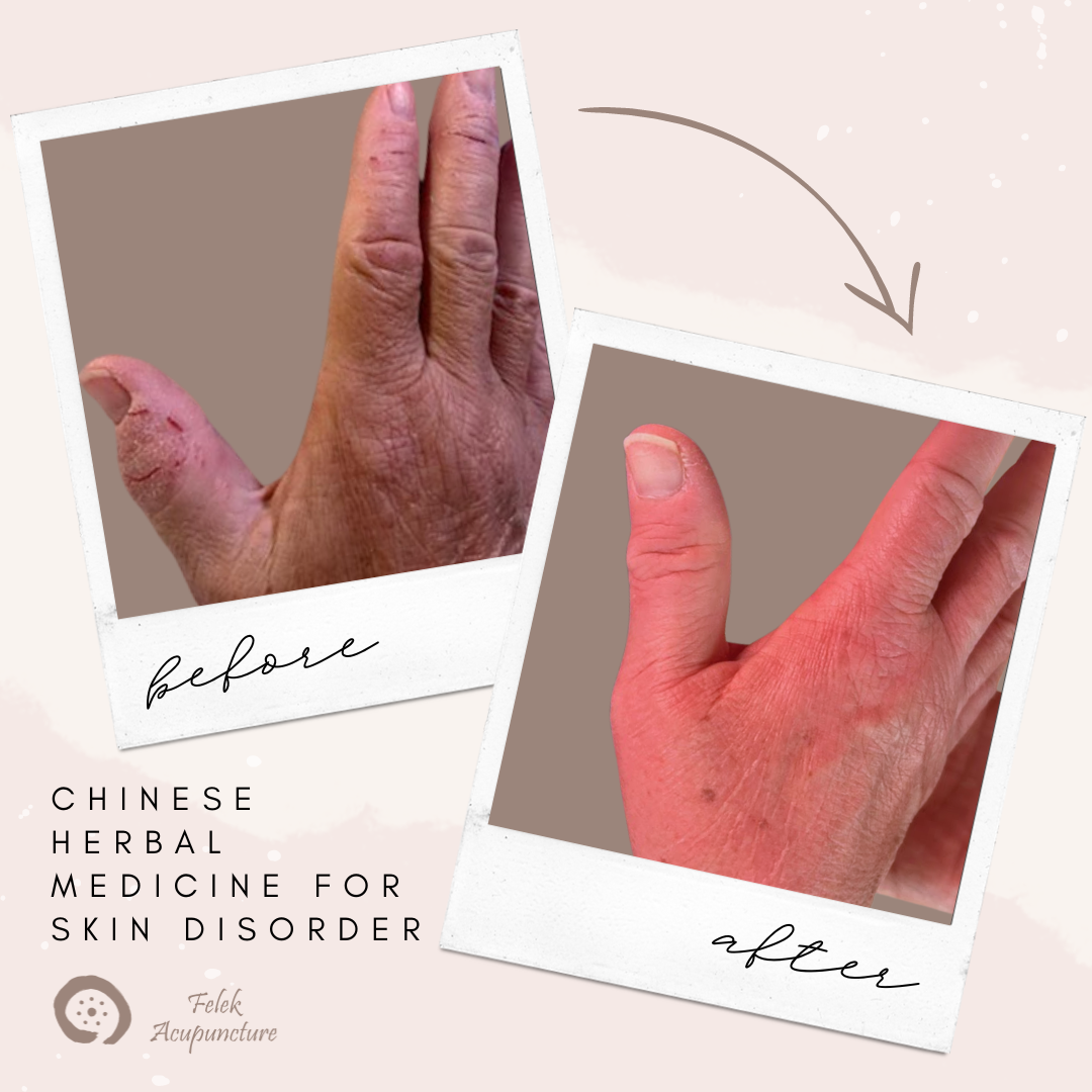 Chinese Herbal Medicine for skin disorders / case study
