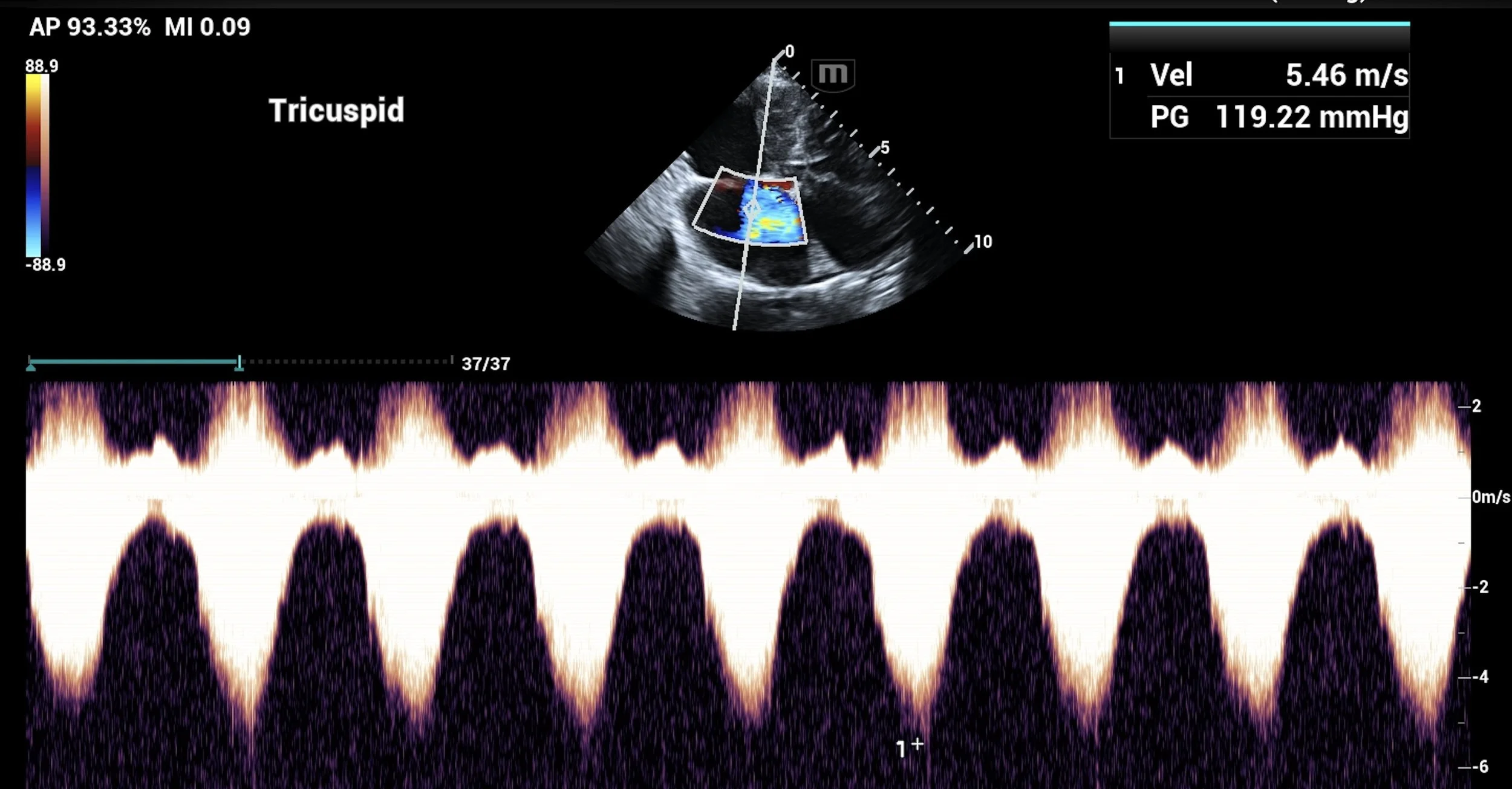 Ultrasound image of the heart showing blood flow in the tricuspid valve using color Doppler. The bottom part displays a spectral Doppler waveform measuring blood flow velocity.