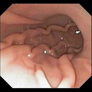 Endoscopic image  showing the intestinal walls and folds.