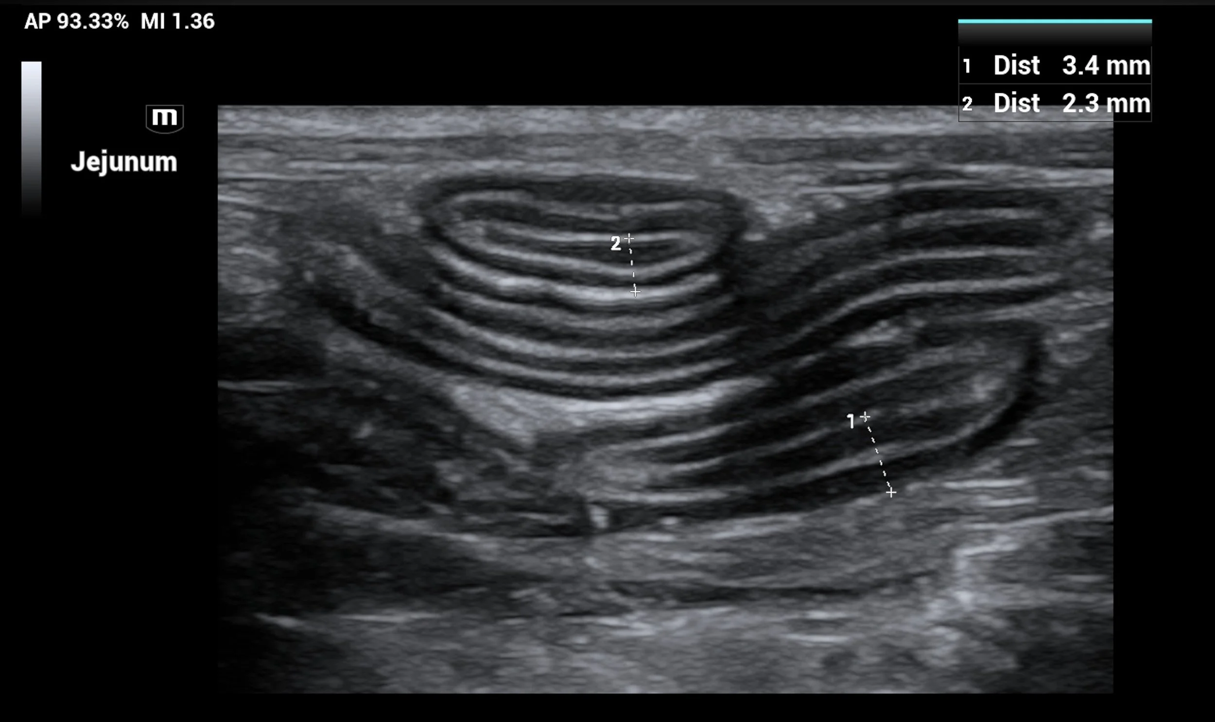 Ultrasound image of a section of the jejunum, showing concentric circular layers consistent with the intestinal wall