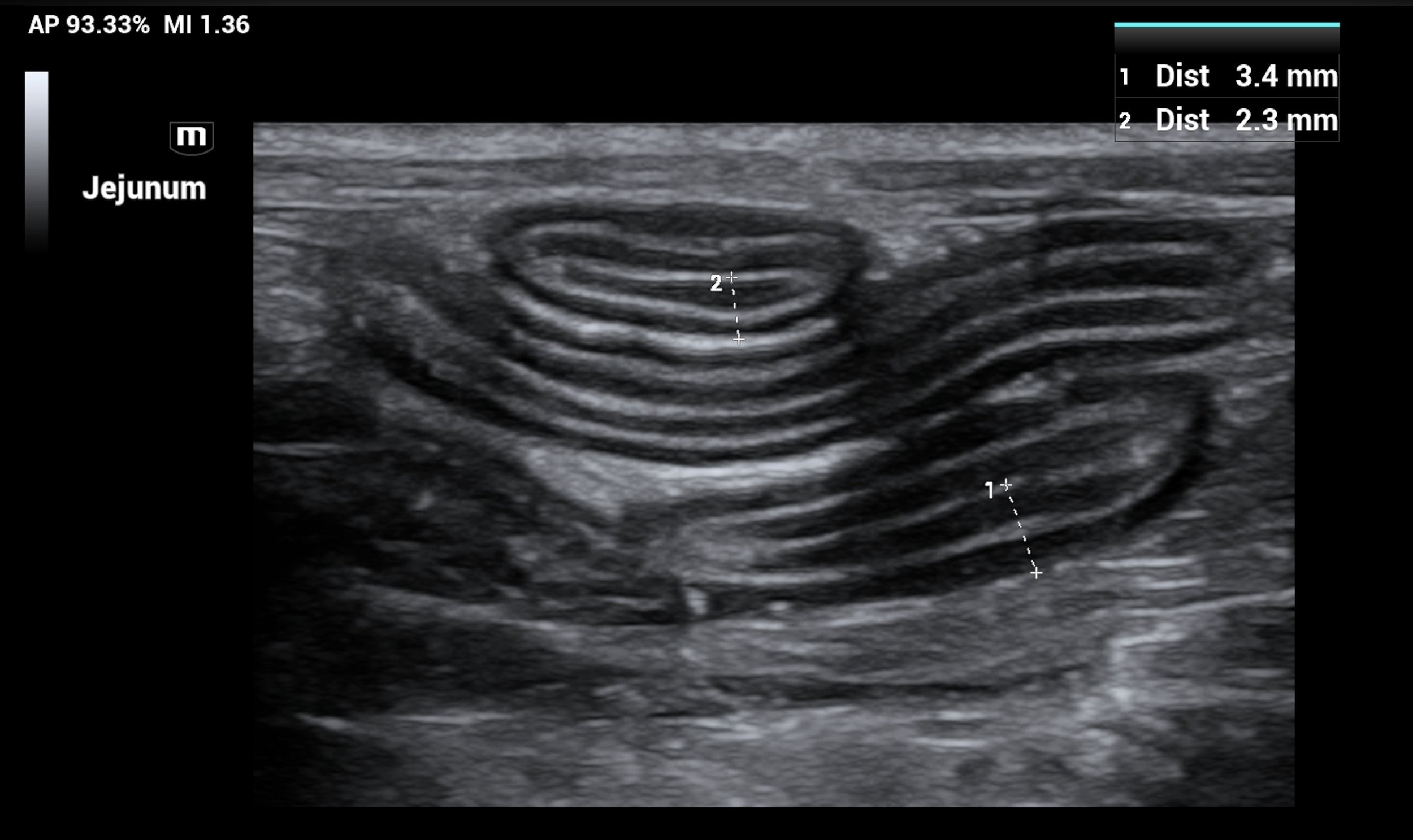 Ultrasound image of a jejunum