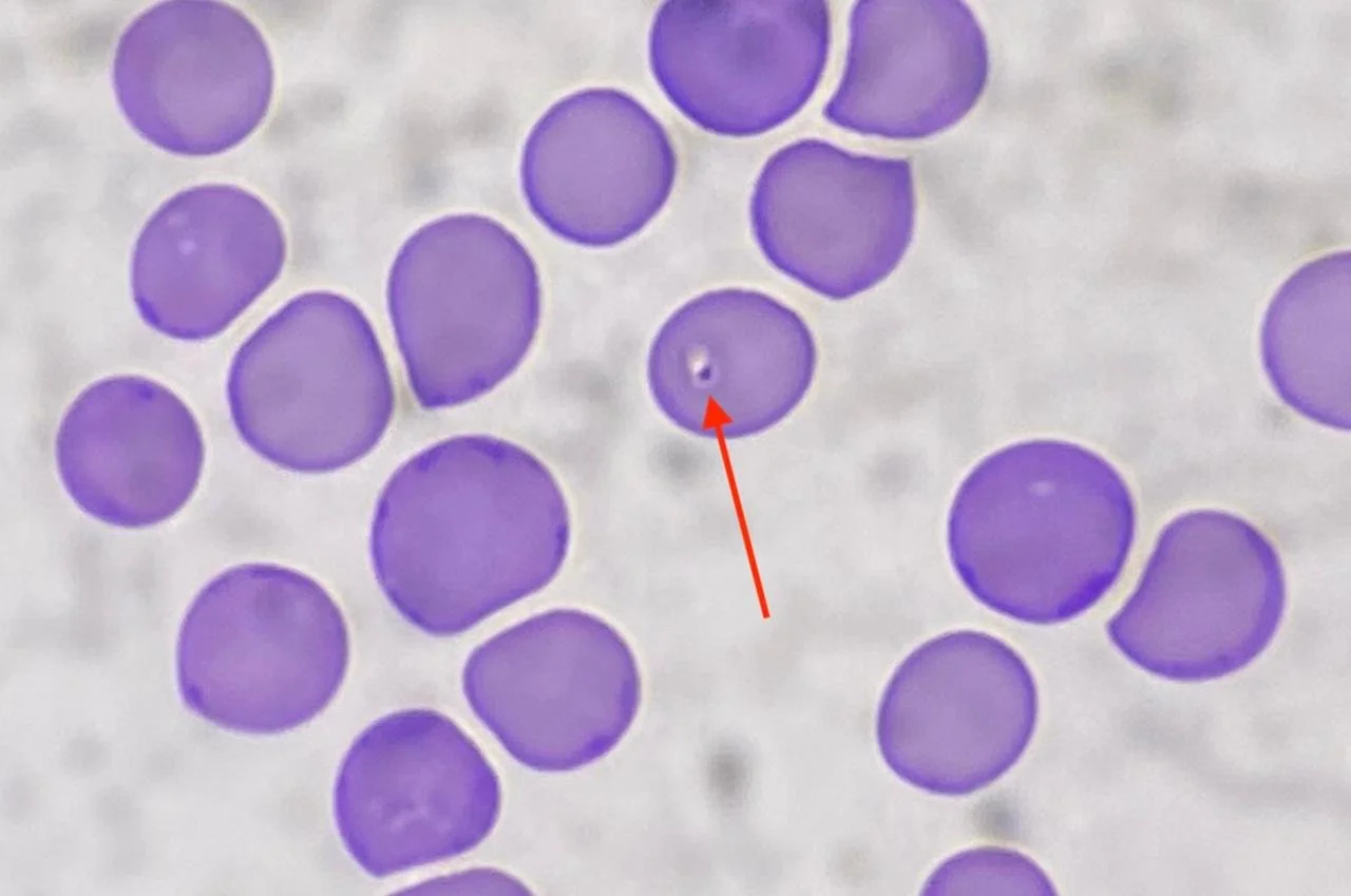 Microscopic view of purple blood cells with a single white blood cell marked by a red arrow.