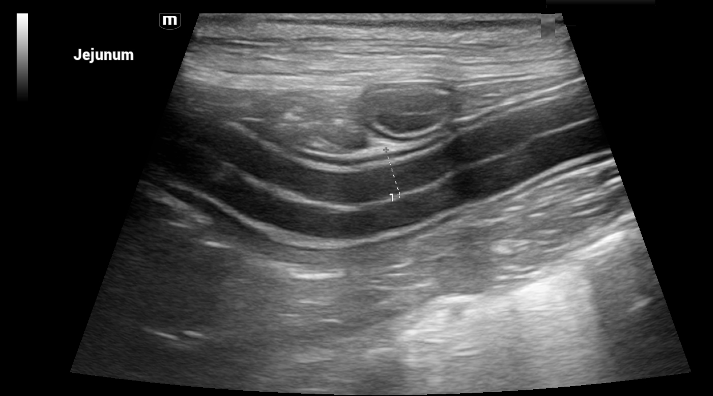 Ultrasound image of Jejunum