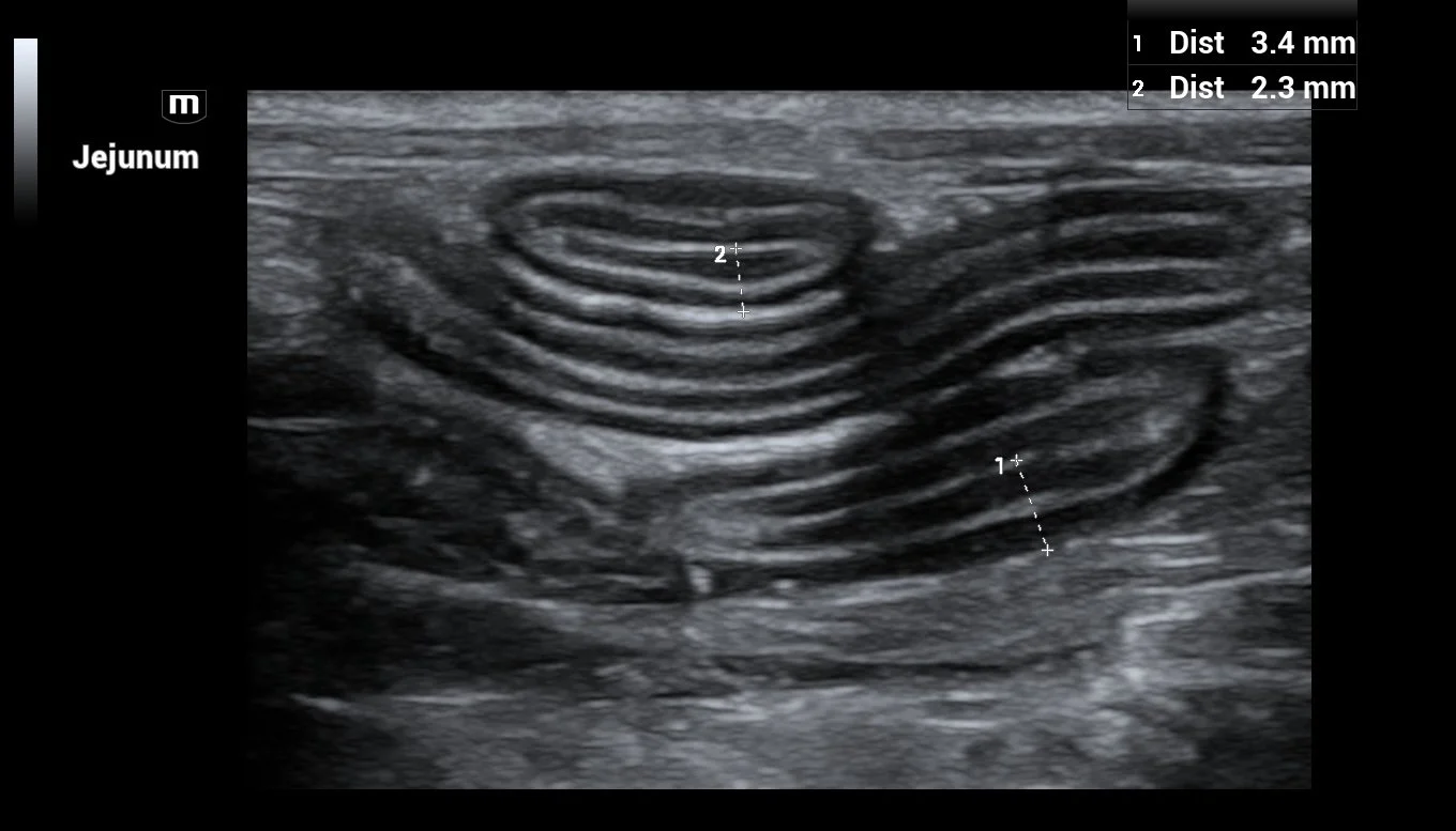 Ultrasound image of a section of jejunum with visible spiral-shaped intestinal folds.