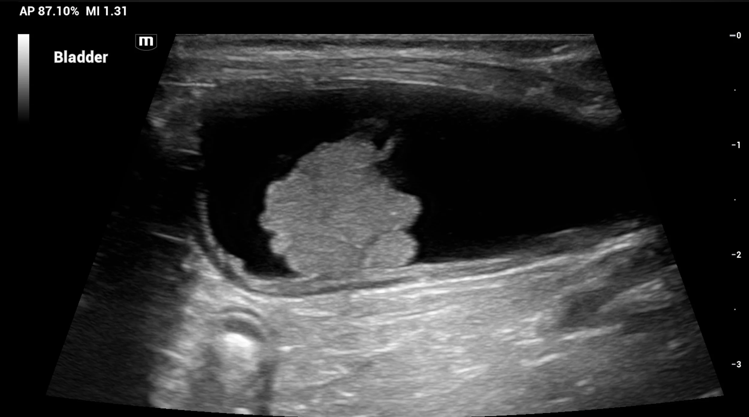 Ultrasound image of a bladder mass inside of a urinary bladder.
