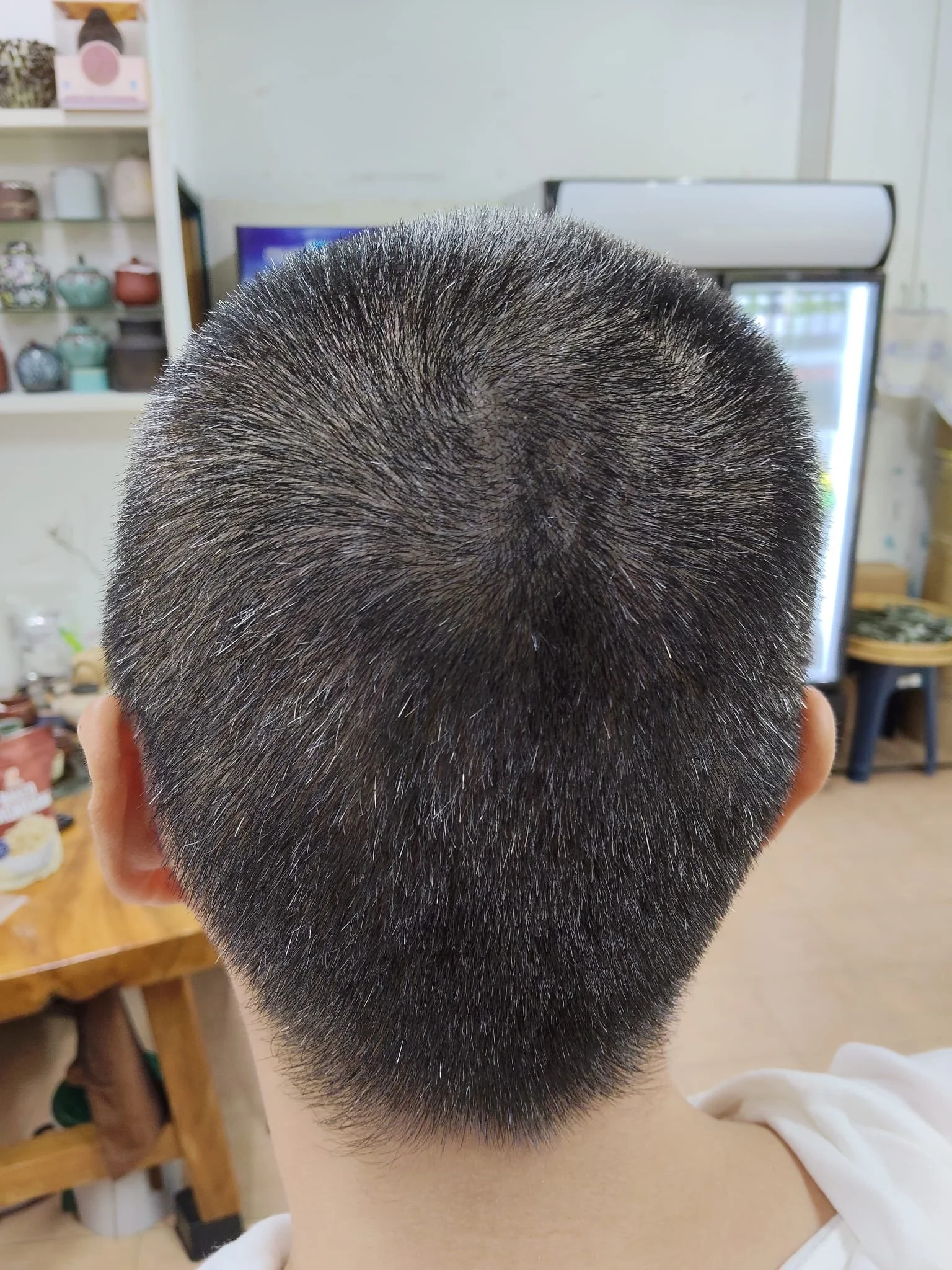 Psoriasis (银屑病)