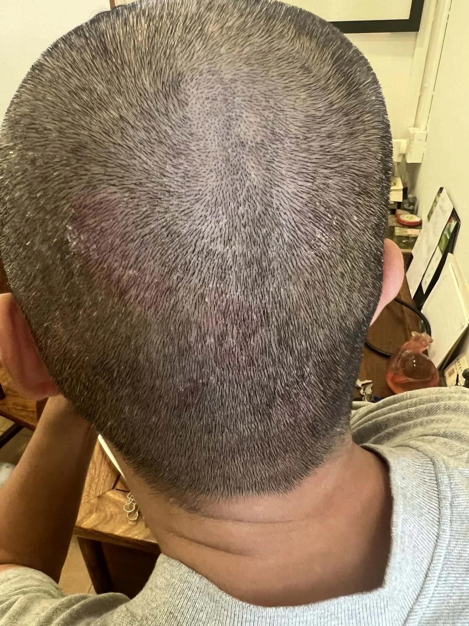 Psoriasis (银屑病)