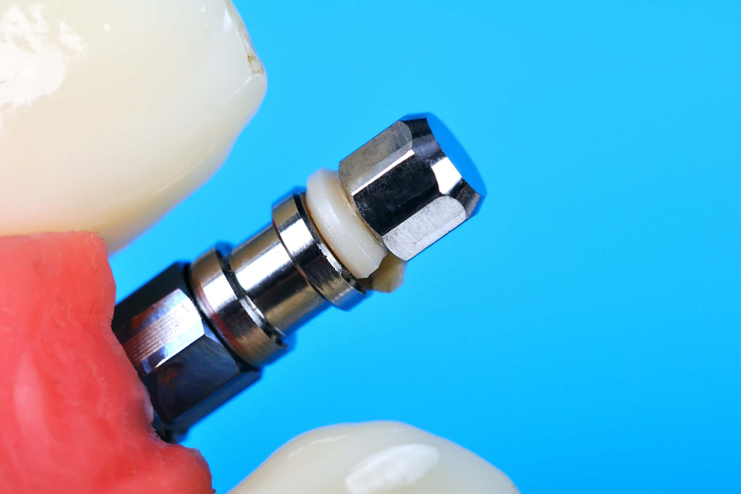 Advantages of Dental Implants for the Elderly