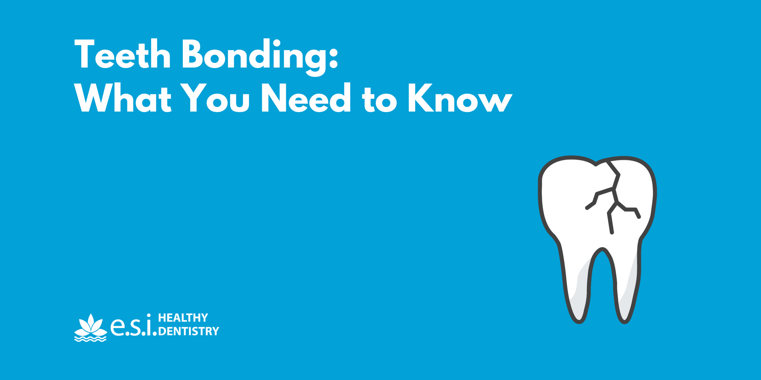 Teeth Bonding: What You Need to Know