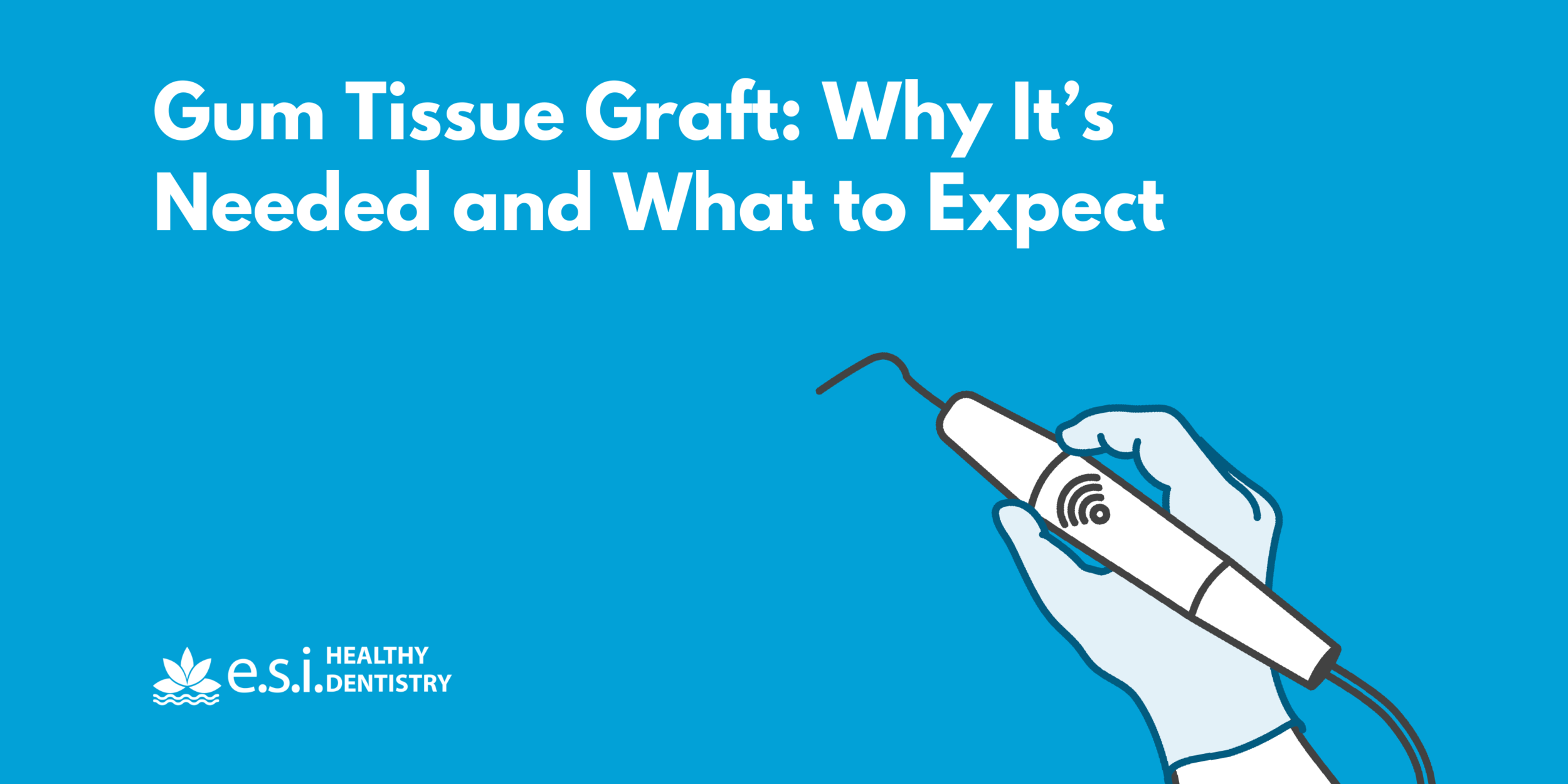 Gum Tissue Graft: Why It’s Needed and What to Expect