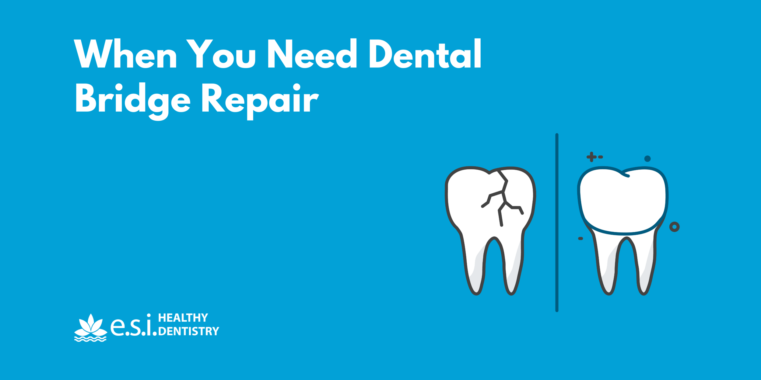 When You Need Dental Bridge Repair