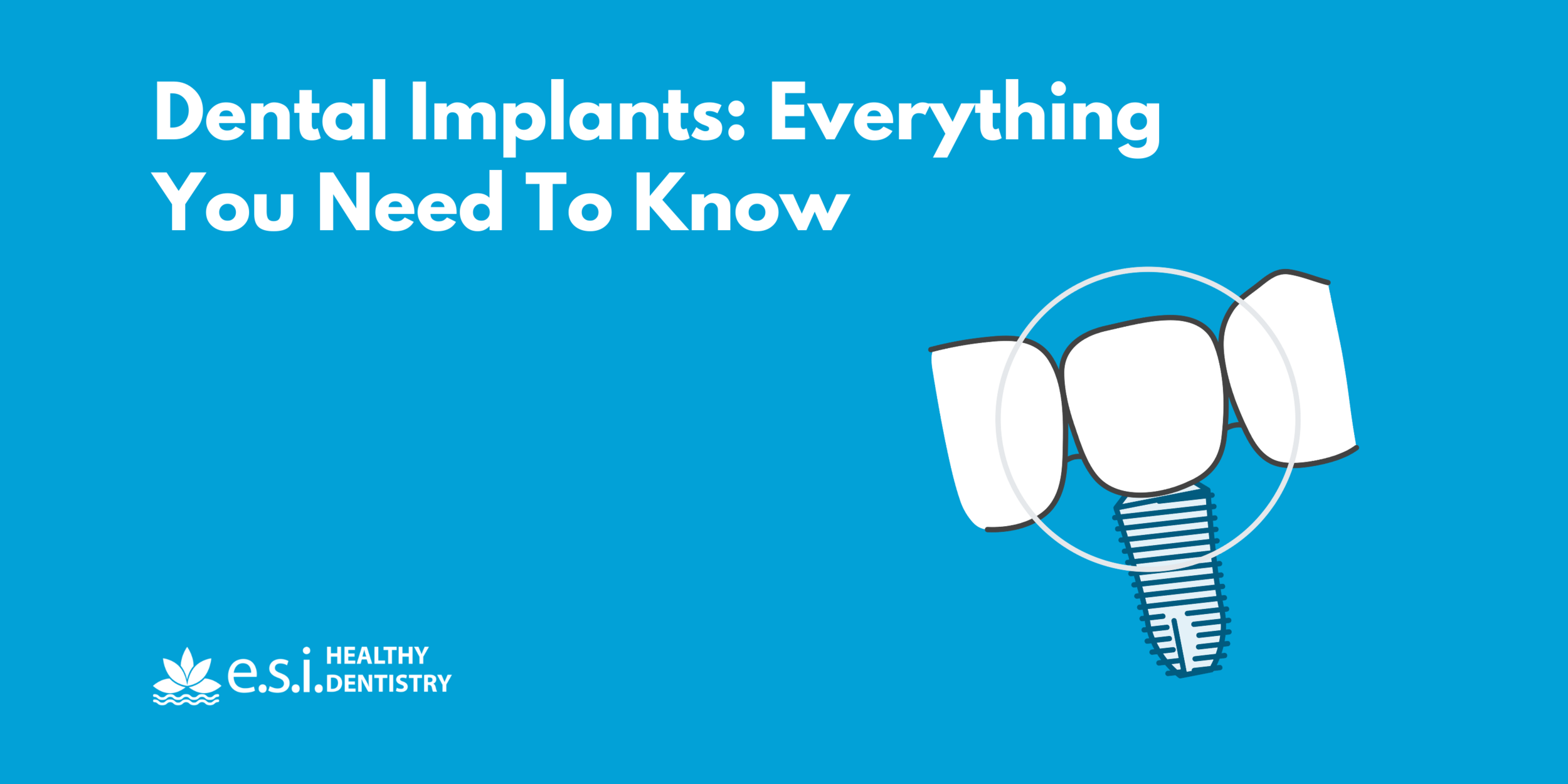 Dental Implants: Everything You Need To Know