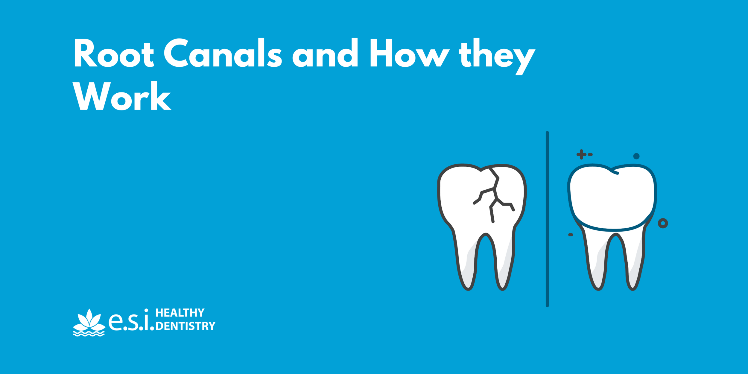 Root Canals and How they Work
