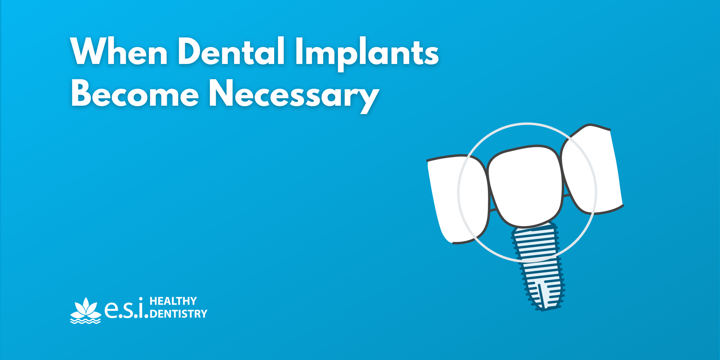 When Dental Implants Become Necessary