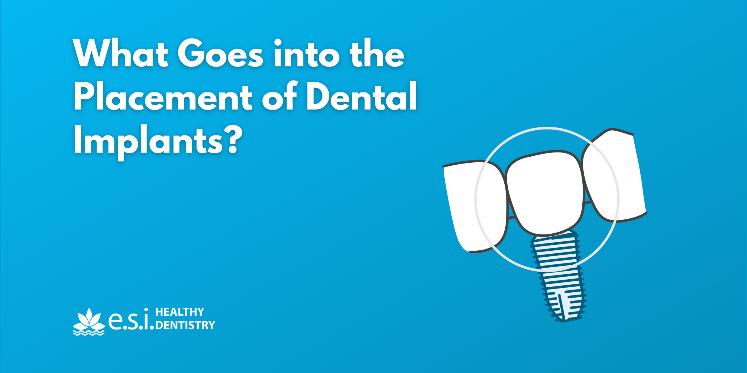 What Goes into the Placement of Dental Implants?
