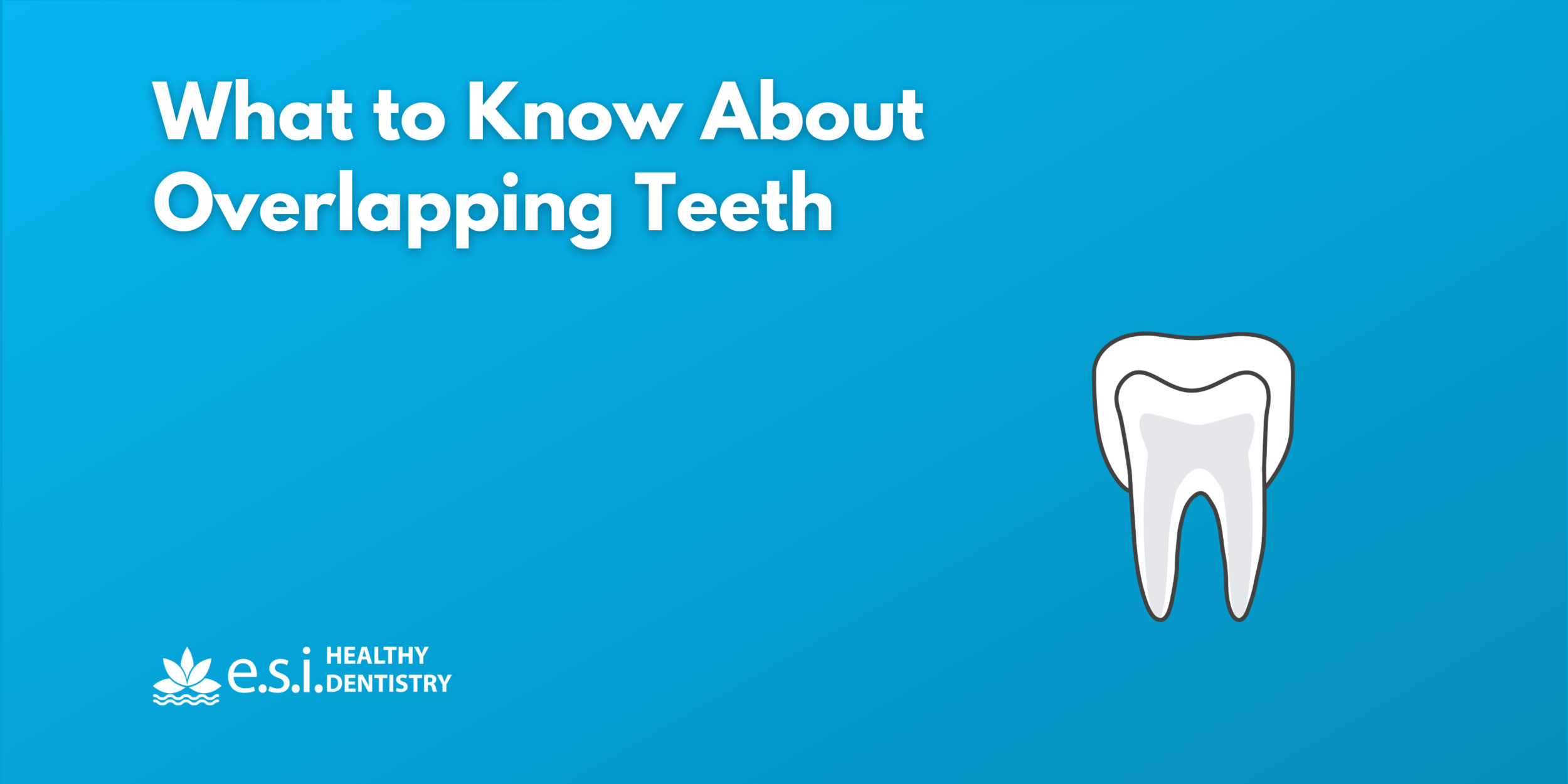 What to Know About Overlapping Teeth