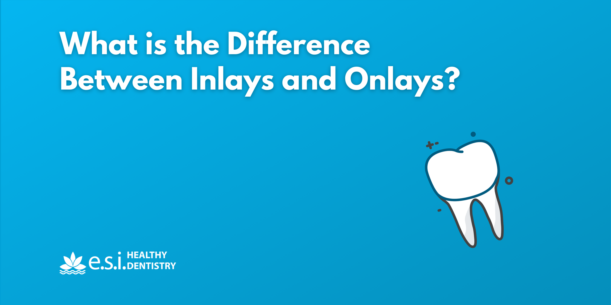 What is the Difference Between Inlays and Onlays?