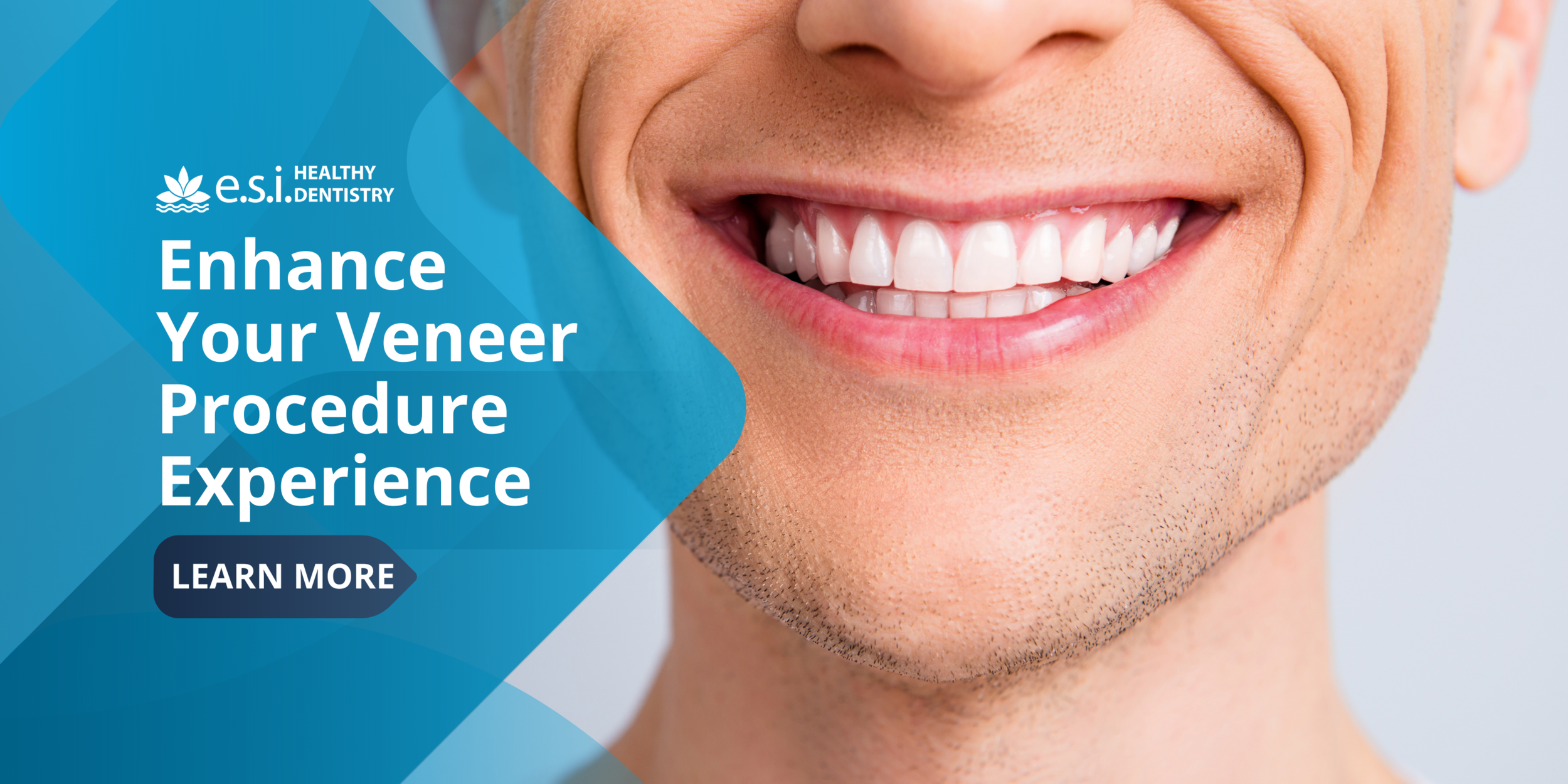 How e.s.i. Can Enhance Your Veneer Procedure Experience