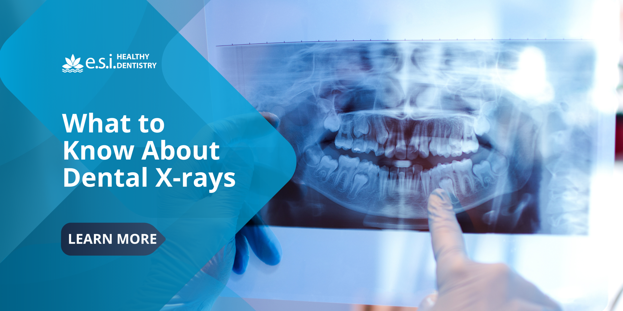 What to Know About Dental X-rays