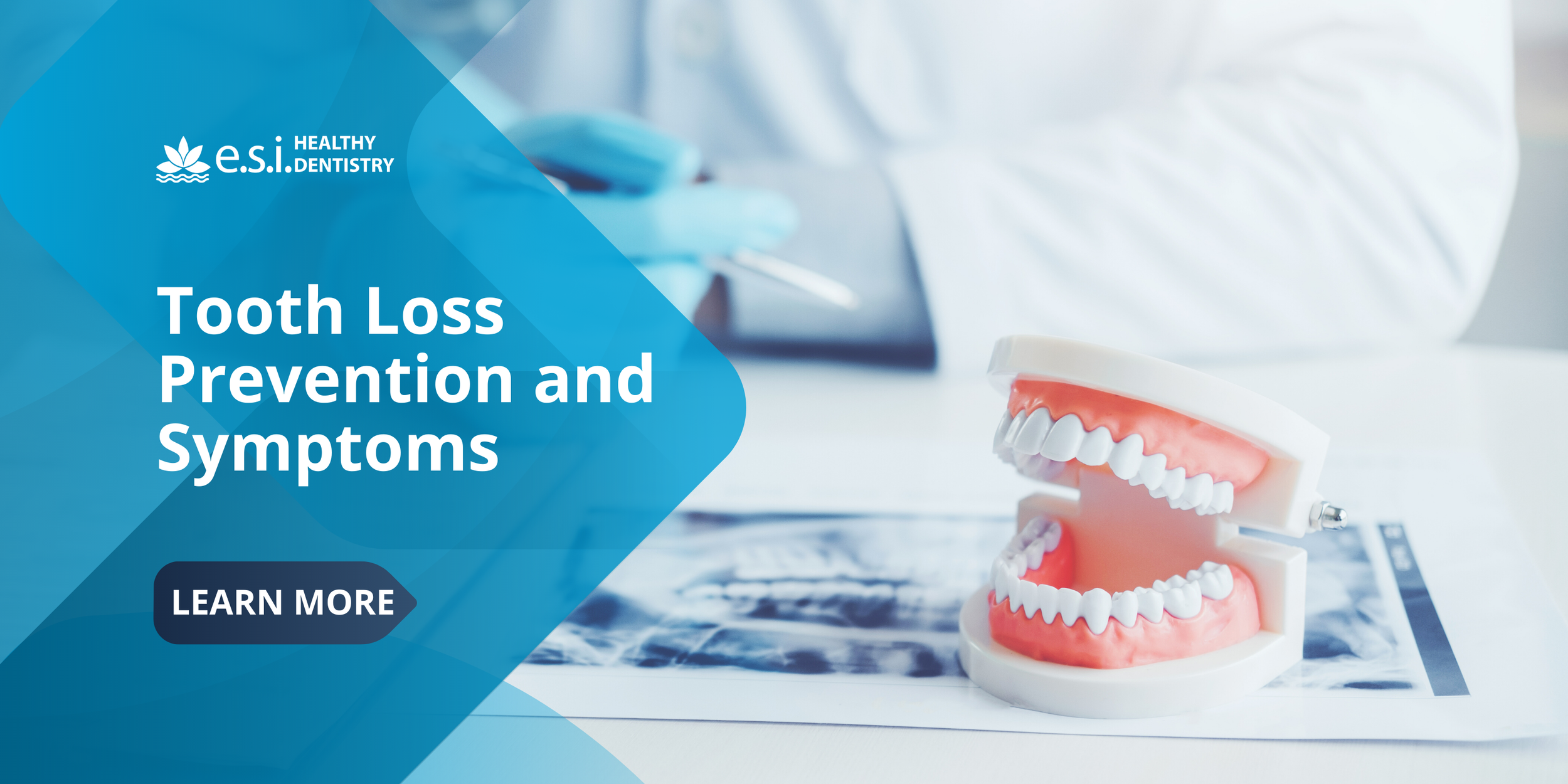 Tooth Loss Prevention and Symptoms