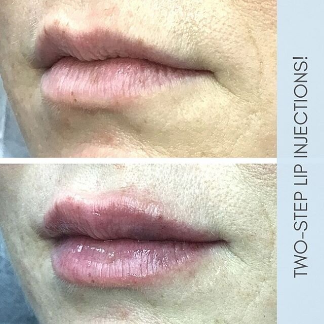 A perfect example of a client who did NOT want lips that crossed the line into being super full.⁣
⁣
Here's how we ensured this beauty absolutely loved her results:⁣
⁣
We brought her for a consult and then got her scheduled for an initial round of min