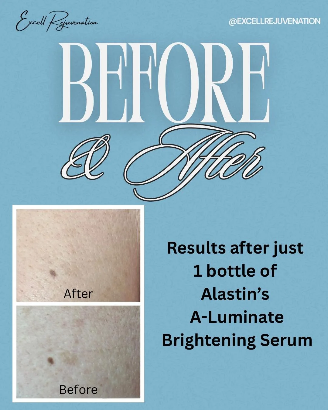 ✨ Look at these results after just ONE bottle of Alastin A-Luminate Brightening Serum ✨

Targeted brightening + skin-supporting technology = visibly more even tone and reduced discoloration without harsh ingredients.

🦋 LIMITED-TIME OFFER
Enjoy $50 