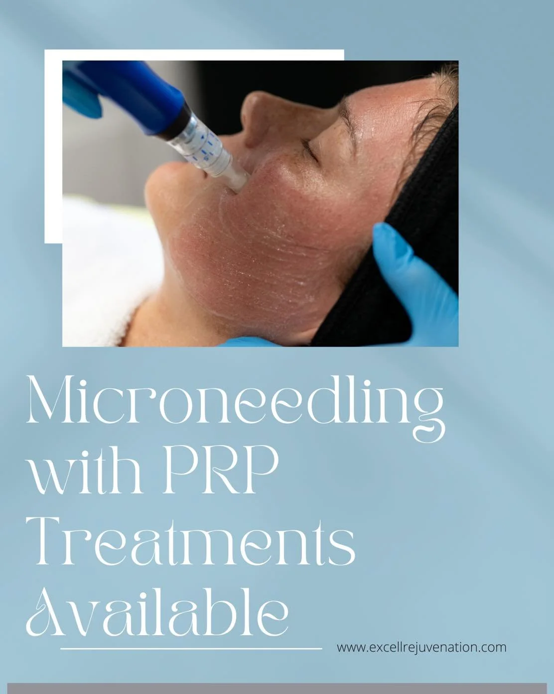✨ READY FOR REAL SKIN TRANSFORMATION? 

This February, commit to your glow:

3 Microneedling with PRP Sessions for $1,350
🎁 + $100 SkinPen e-Gift Card

Microneedling stimulates natural collagen production to improve:
✔️ Fine lines + wrinkles
✔️ Acne