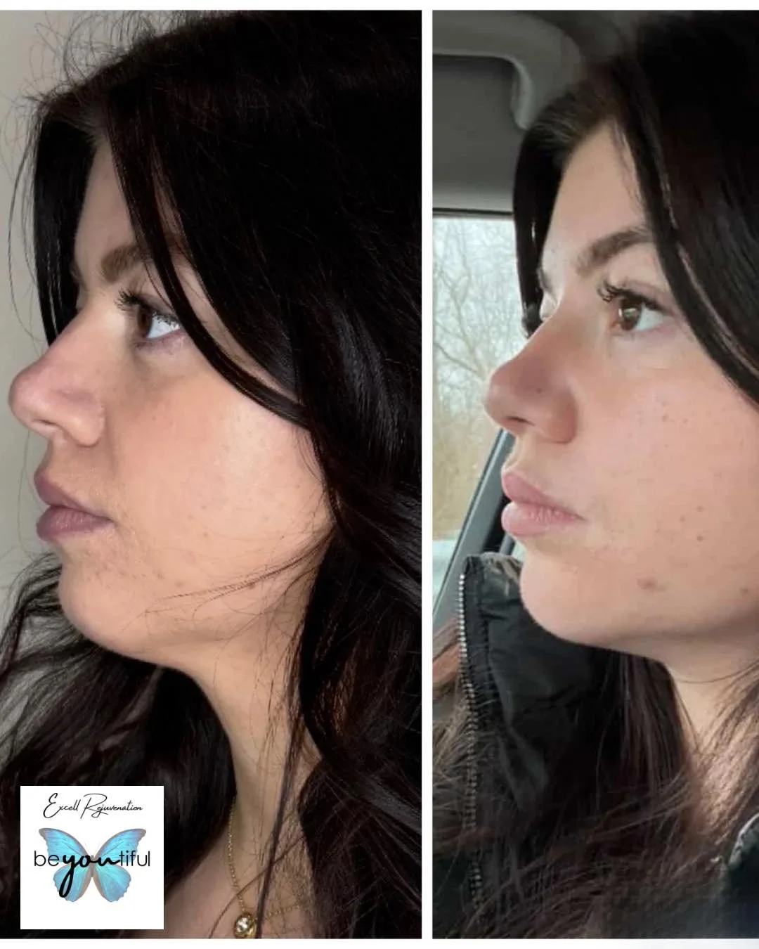 🦋 LOOK AT THESE RESULTS 🦋

2 vials of Revanesse Versa placed in the chin + jawline to improve structure and projection for a more balanced profile.

Subtle? Yes.
Noticeable? Absolutely.

By enhancing the chin and defining the jawline, we create bet