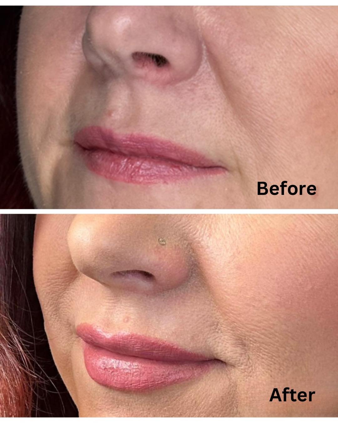 💋 A Little Filler. A Big Difference. 

Subtle, natural-looking volume can enhance your lips while still looking like you.

This month, enjoy $50 OFF dermal filler and achieve the refreshed, balanced look you&rsquo;ve been wanting!

✔️ Enhance volume