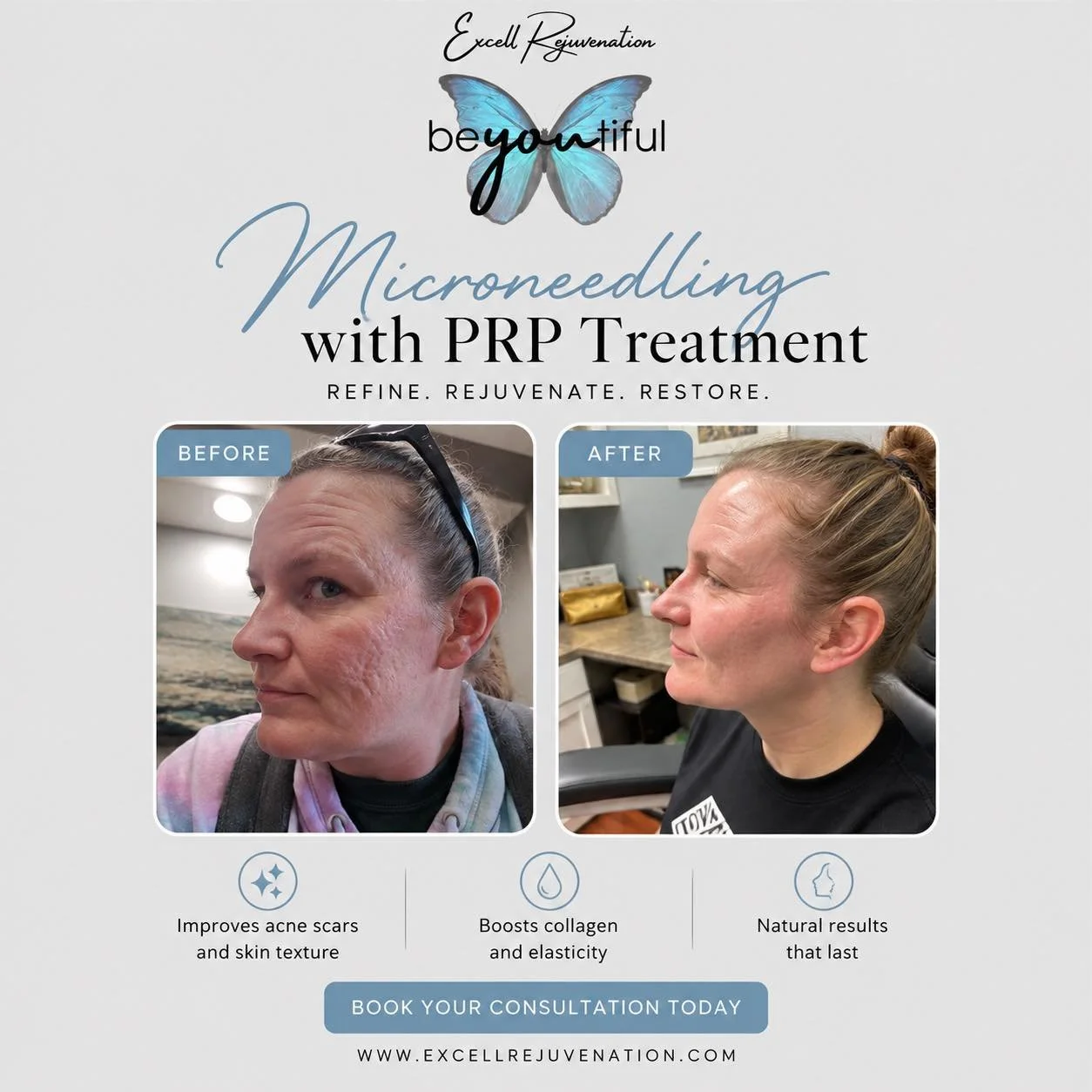Last few days to save!

Look at these results after several Microneedling with PRP sessions! 🤩 Smoother texture, improved acne scarring, and healthier-looking skin.

✨ 3 sessions for $1,300 (regularly $1,500)

Don&rsquo;t miss your chance to grab th