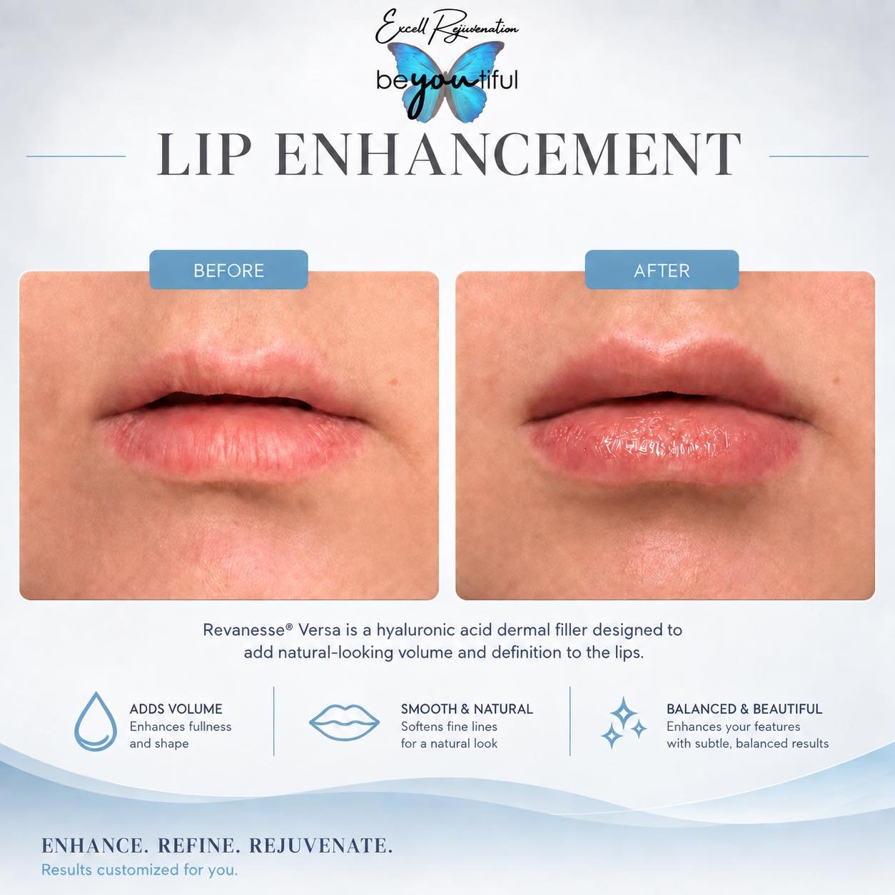 Enhance, don&rsquo;t change. 💋 Soft, balanced and beautifully natural-looking lips.

Call 317-660-0888 to schedule your consultation!

#NaturalLipFiller #LipEnhancement #LipFillerResults #NaturalResults #SubtleEnhancement #IndyAesthetics #Indianapol