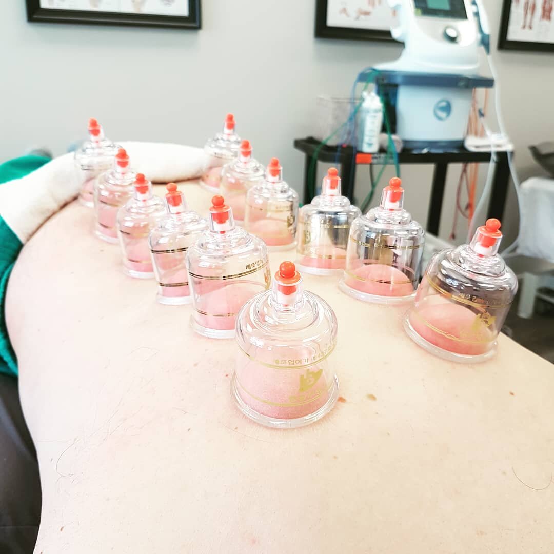 Haven't tried cupping yet?? If you need to improve blood flow, have poor circulation and need to increase mobility, then cupping might be the right treatment for you!!

Call Let's Get Physio Muskoka for a consultation 705-788-7878
#letsgetphysiomusko